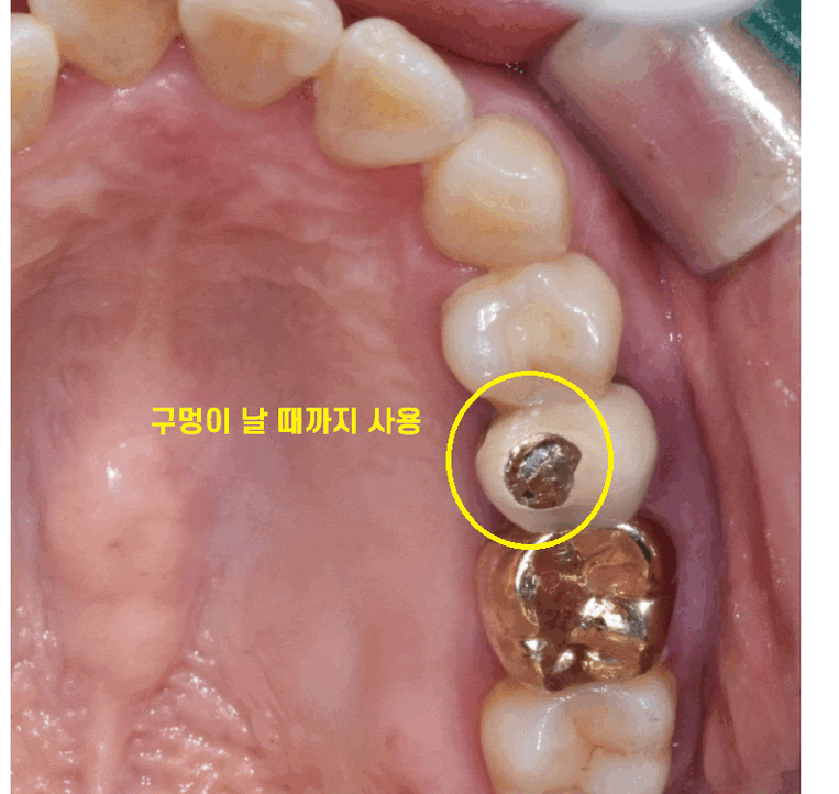 덕풍동 치과 씹을때 통증 임플란트로 극복했습니다. 관련 이미지 1