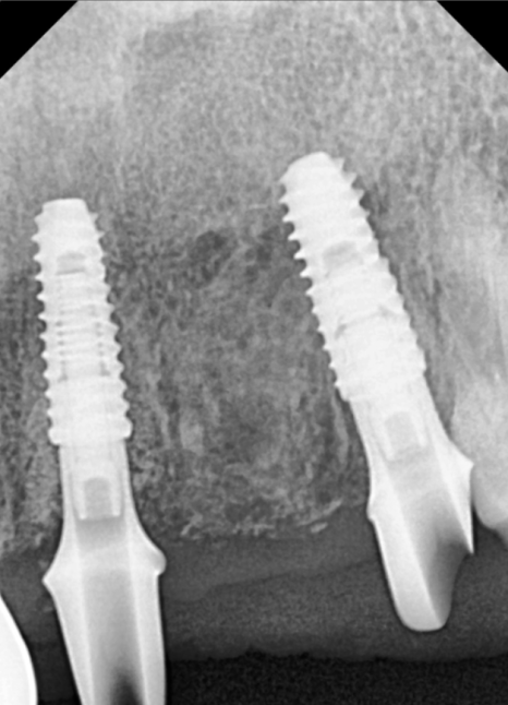 오래된 앞니 크라운 냄새, 관련 이미지 11