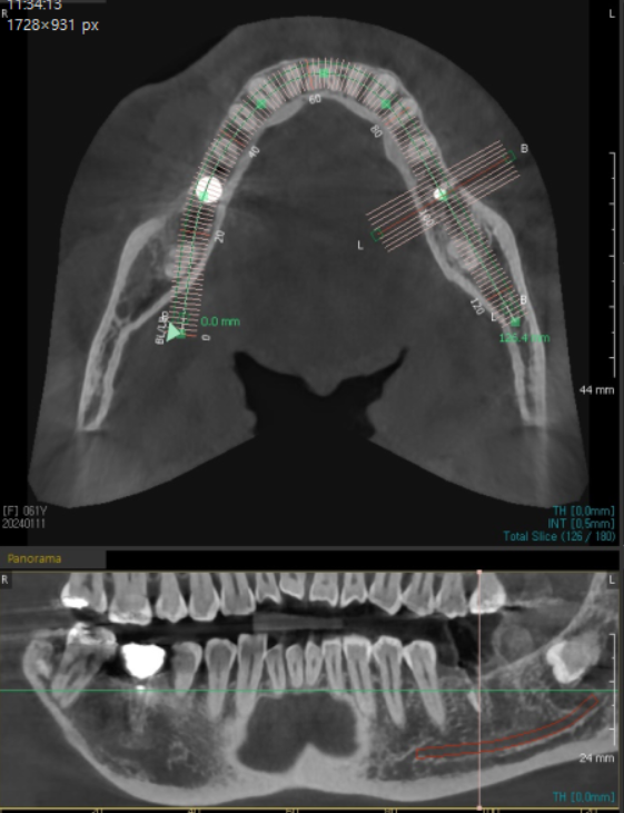 풍산동 치과 아래 어금니 임플란트 뼈 이식 없이 해결했습니다. 관련 이미지 4