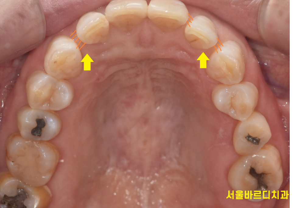 고덕동 교정치과 앞니 사이 틈 부분교정으로 치아 삭제없이 공간 없애기 관련 이미지 2