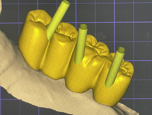 미사 임플란트 70대 연령과 상관없는 치료 과정 관련 이미지 9