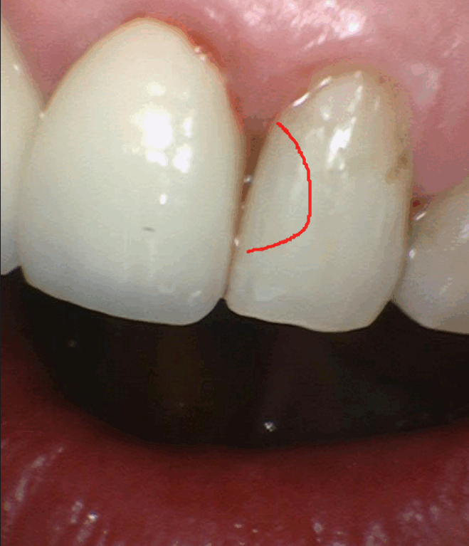 미사역 치과 앞니 충치 레진으로 당일 수복 완료하였습니다. 관련 이미지 1