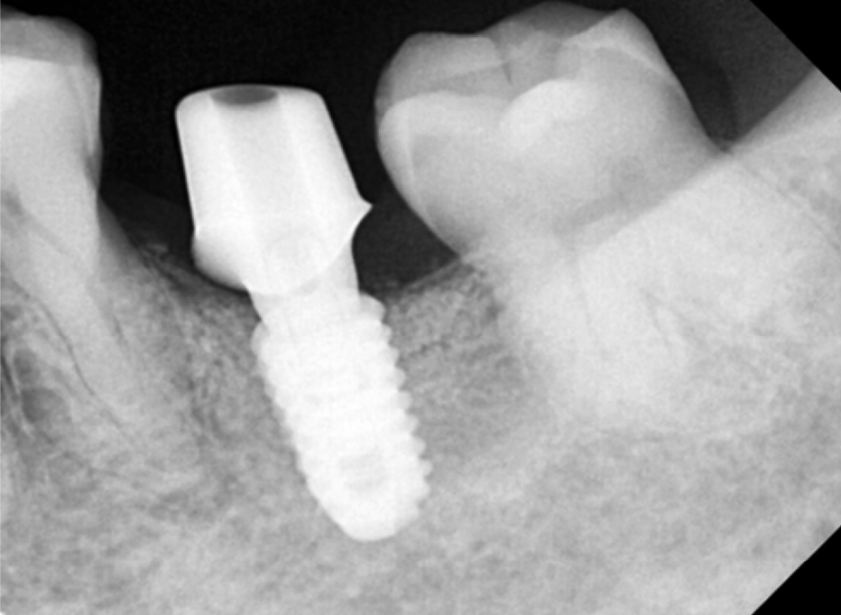 고덕동치과 서울바르디치과 전치부 및 구치부 임플란트 치료증례 #9 관련 이미지 27