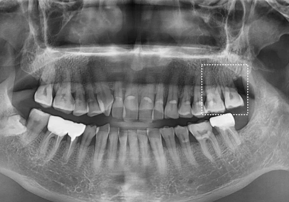 어금니 금 감, 치아 살릴 수 있는 기준은 바로 관련 이미지 3