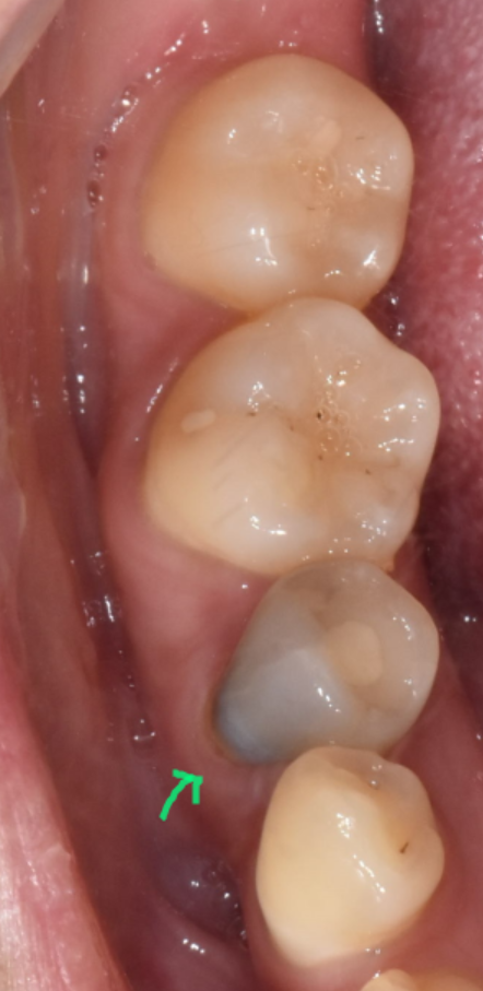 치아 멍 까맣게 변했어요 변색되고 괴사되었을 때 대처법 공개 관련 이미지 4