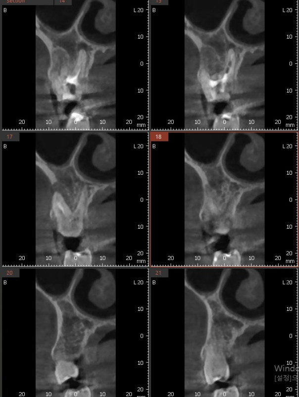 발치 대신 신경치료 뽑기 전 치료는 한번 해봐야하지않을까요? 관련 이미지 9