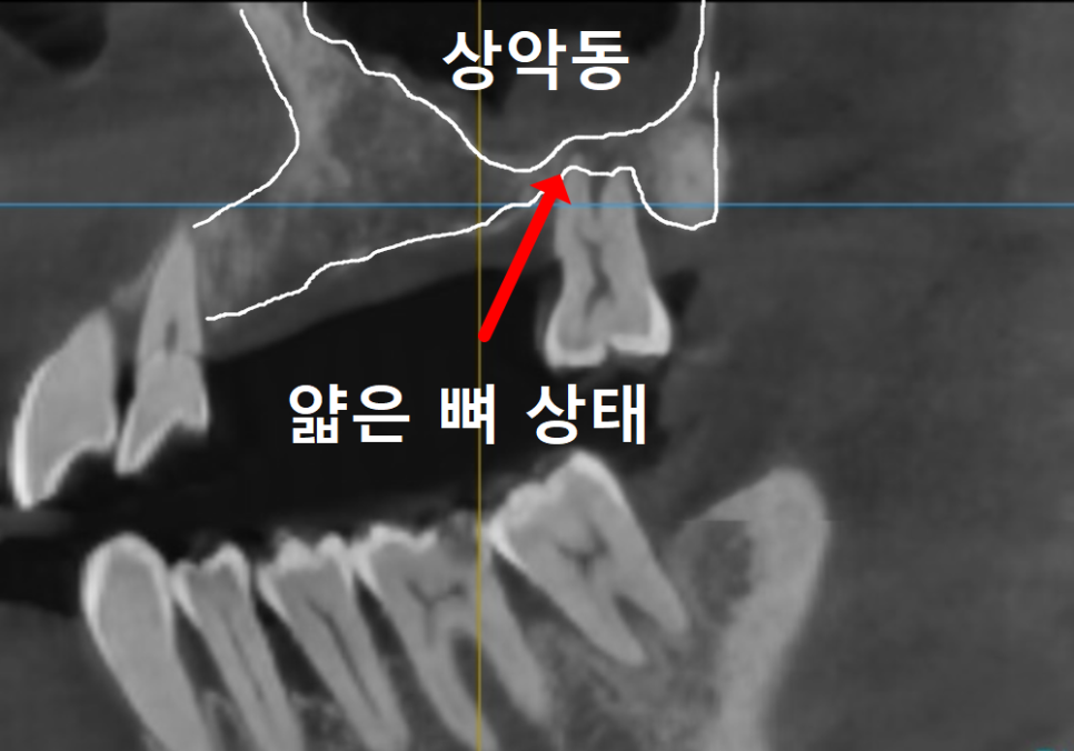 위 턱 전체 임플란트 vs 부분 틀니, 나에게 꼭 필요한 치료법 찾기 관련 이미지 11