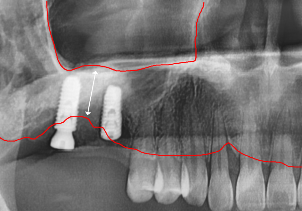 상악동 거상술 부작용 걱정되시나요? 재수술 없는 뼈이식의 정석 공개 관련 이미지 13