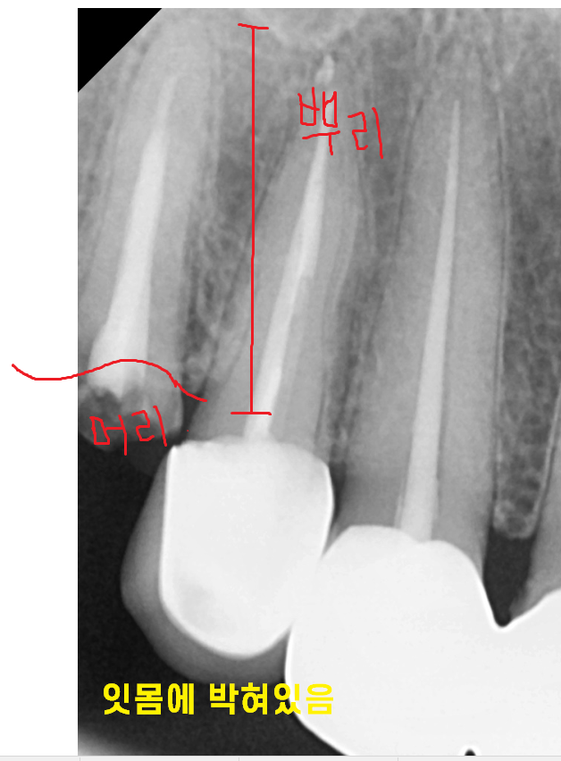 보철 부러짐 발생으로 치아 뿌리만 남았을 때 치료 방법 임플란트 관련 이미지 5