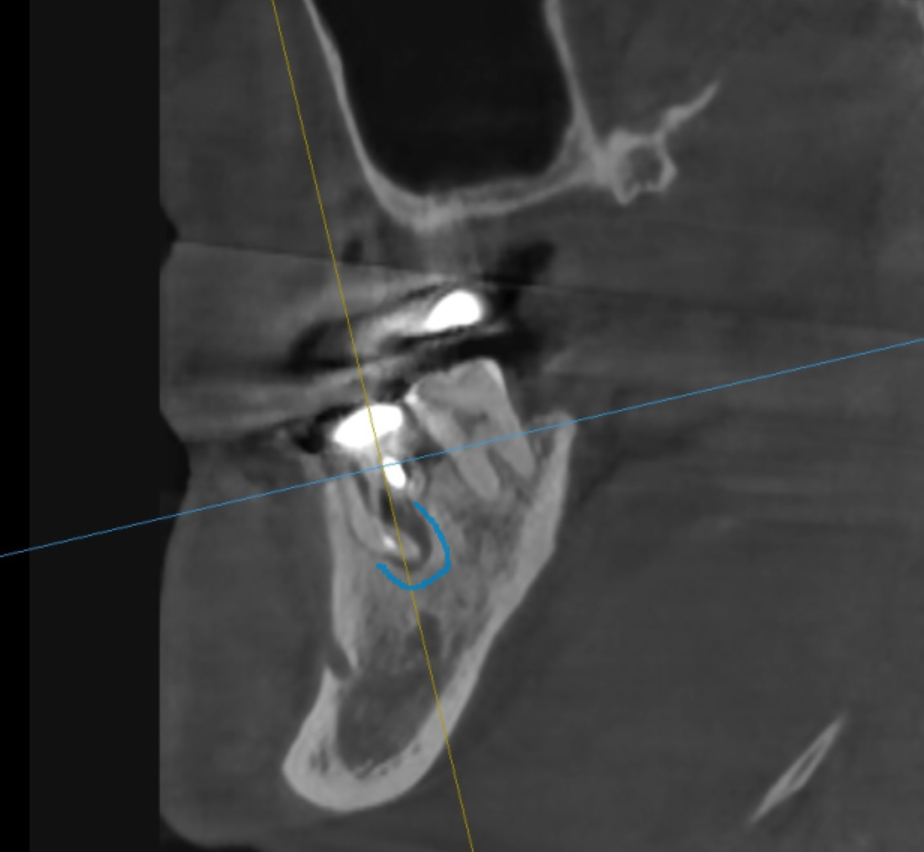Implant treatment is needed when a gum pimple or pus appears. image 4