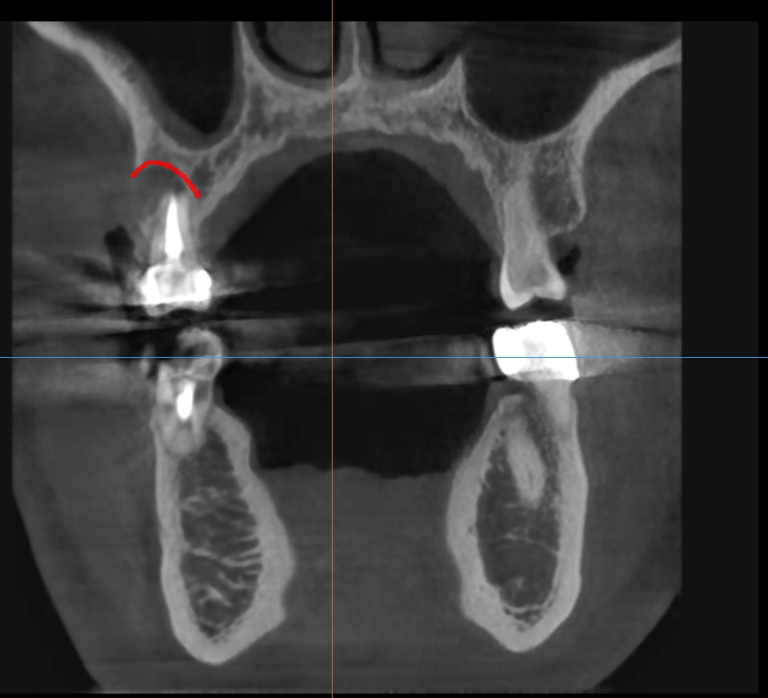 하남시청치과 신경치료 치아 발치 후 임플란트 했습니다. 관련 이미지 4