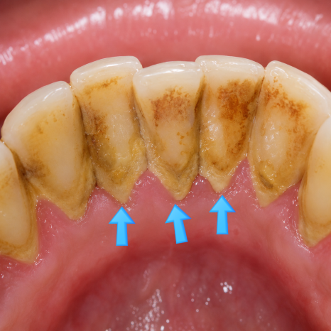 My Teeth Feel More Sensitive After Scaling (+ Causes and Ways to Reduce Sensitivity) image 1