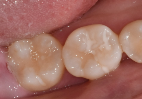 고덕동 사랑니 매복 발치, 안 아픈데 꼭 빼야 하나요? 관련 이미지 7