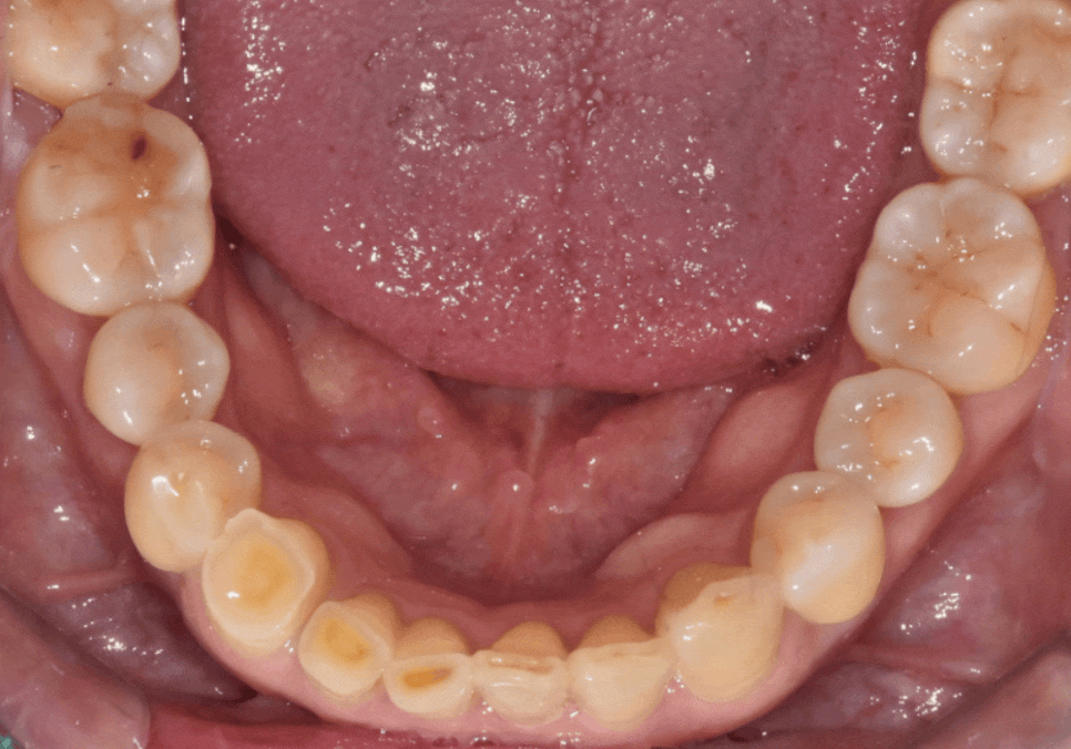 고덕동 심미 보철, 삐뚤어진 앞니, 교정 없이 바로잡은 비결 관련 이미지 2