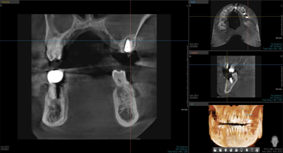 고덕동치과 서울바르디치과 전치부 및 구치부 임플란트 치료증례 #9 관련 이미지 24