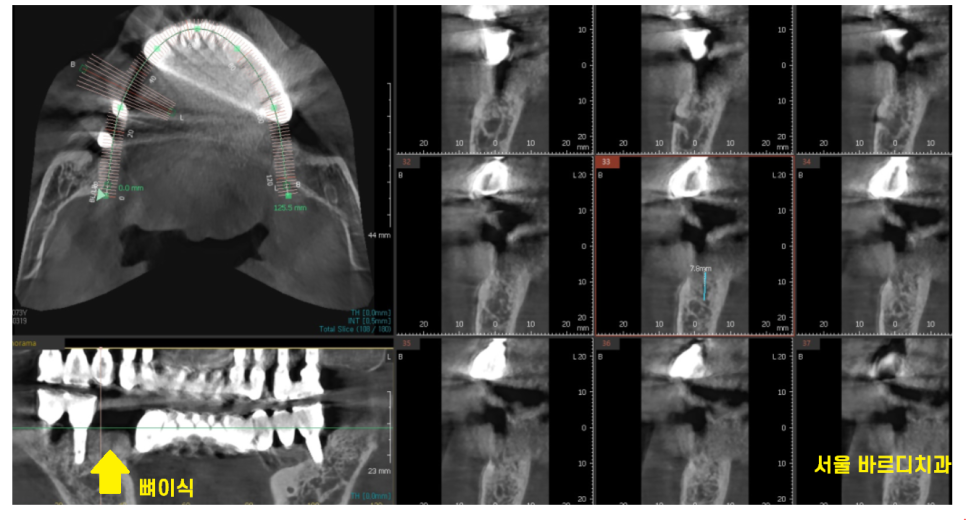 덕소 치과 발치 후 당일 뼈이식의 중요성 설명드립니다!! 관련 이미지 8