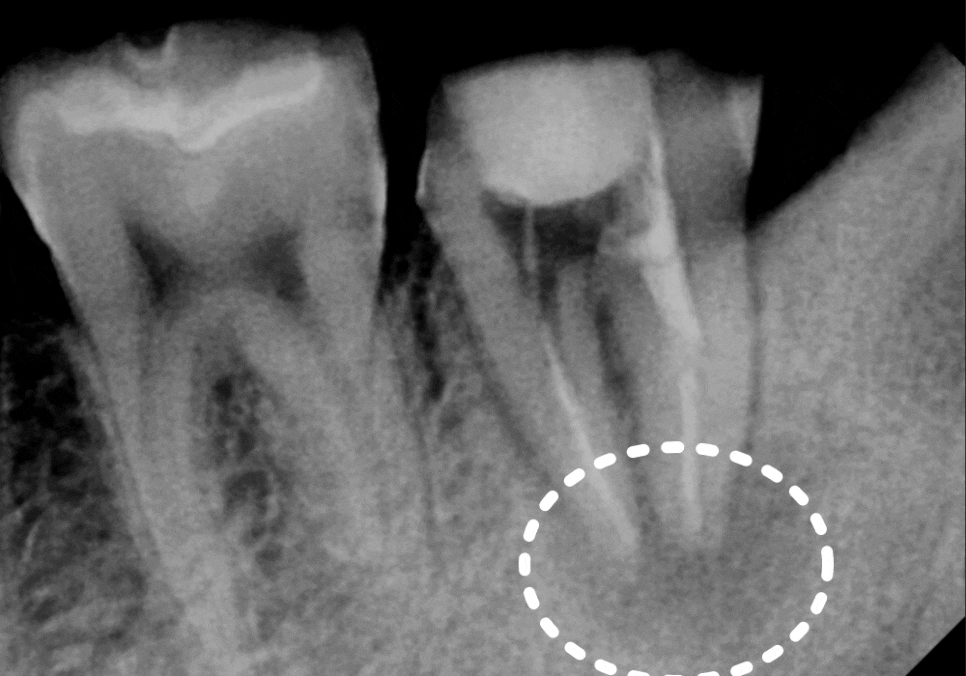 어금니 염증, 자연치 살리기에 진심인 저는 이렇게 살렸습니다. 관련 이미지 12