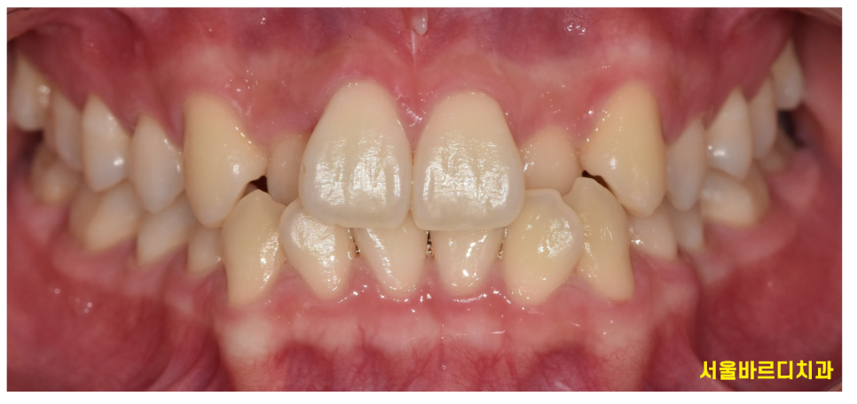 소구치 발치 교정 부작용은 없을까요?? 쌩니를 뽑는거라... 관련 이미지 2