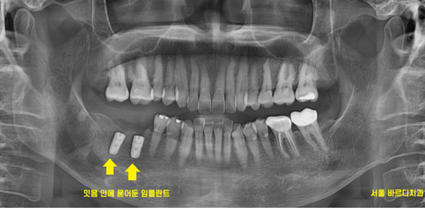 길동 치과 임플란트 2차 수술이요? 예전에 했잖아요 관련 이미지 4