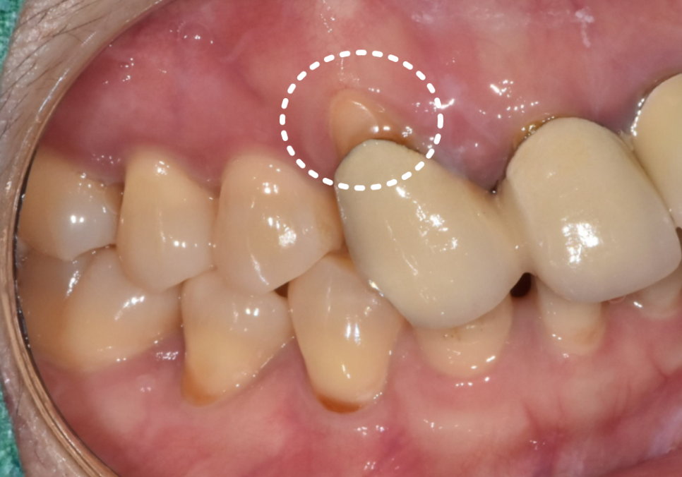 고덕동 심미 보철, 삐뚤어진 앞니, 교정 없이 바로잡은 비결 관련 이미지 4