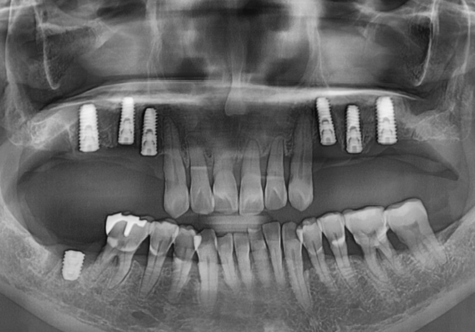 Gangil-dong Molar Implant, "It’s Loose—Can’t You Just Bond It with Resin?" image 13