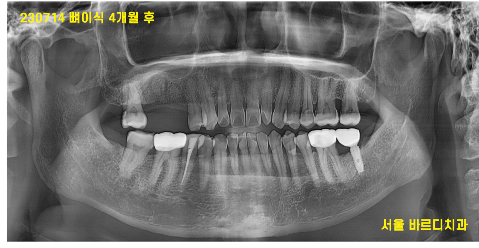 고덕동 치과 잇몸 주저앉음 느낌이 들었다면 늦었을 수도 있습니다. 관련 이미지 9