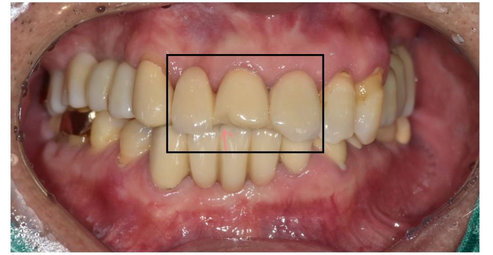 임플란트 대체 수술이 부담스러울 때는 브릿지 치료 관련 이미지 5