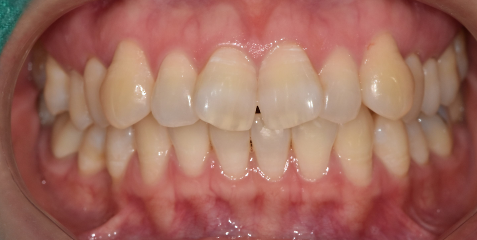 나비 모양 앞니 2가지 방법으로 개선 가능합니다. 관련 이미지 2