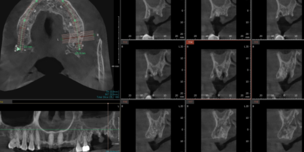 치아 크라운 빠짐 살릴 수 없을 때 강일역 임플란트 관련 이미지 6