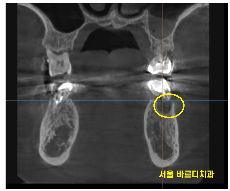 고덕동 치과 어금니 흔들림과 통증 임플란트가 답일 때! 관련 이미지 6