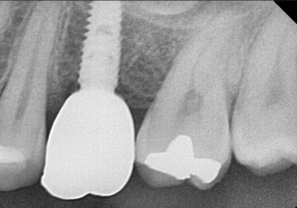 고덕동 치간 이개, 위 앞니 벌어짐, 교정? 라미네이트? 고민이시라면 필독 관련 이미지 12
