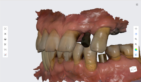 네비게이션 임플란트가 왜 좋다고 그러는거죠? (feat.13가지 장점) 관련 이미지 12