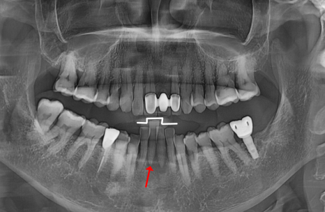 솟구치는 앞니, 흔들리는 치아가 보내는 관련 이미지 2