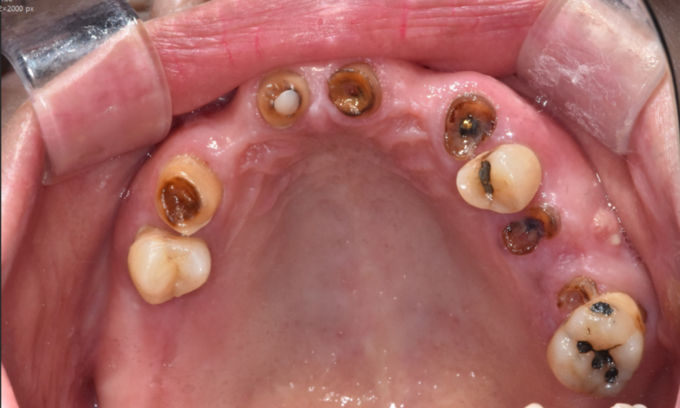 길동 치과 임플란트 틀니 차이 세세하게 대공개 관련 이미지 2