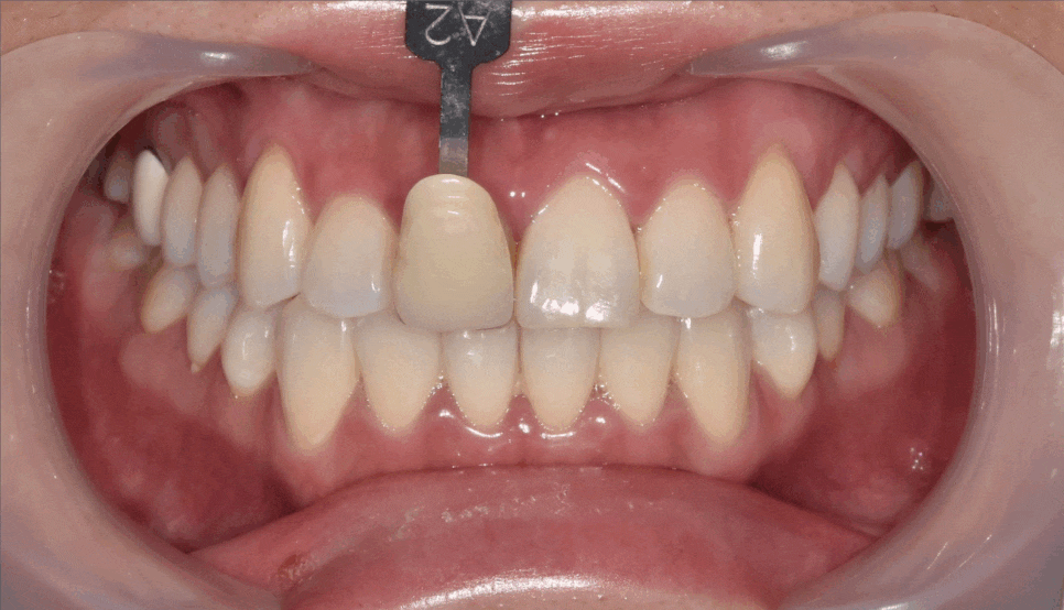 강동구 치아 미백 과정 확인하고 환한 미소로 웃어봐요 우리 관련 이미지 1