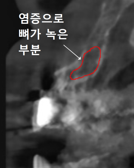 앞니 고름, 잇몸약을 먹어도 왜 염증이 가라앉지 않을까요? 관련 이미지 8