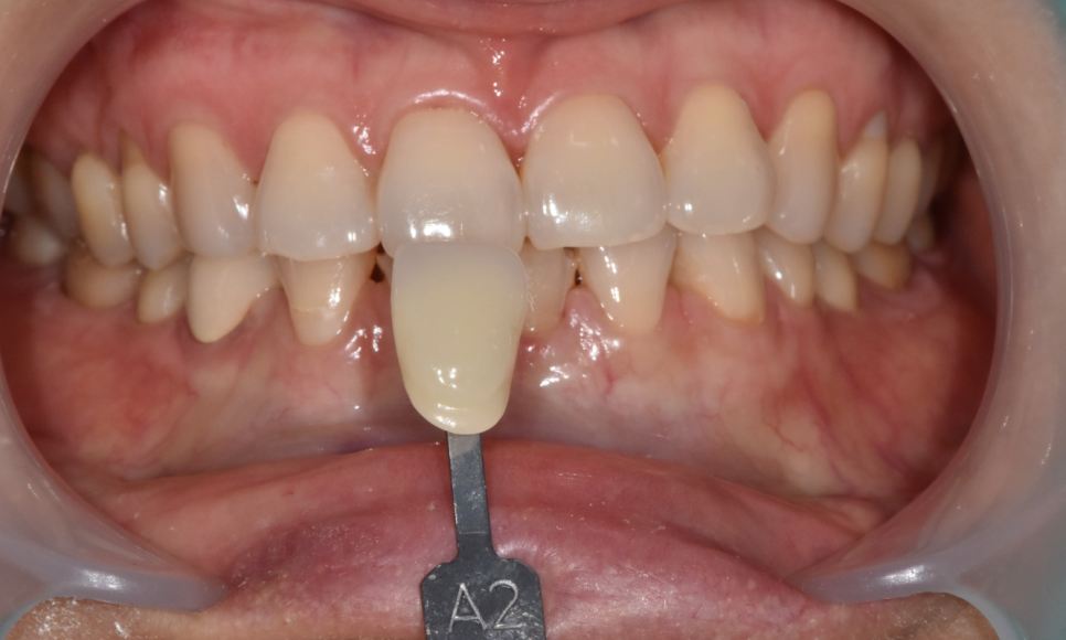 고덕동 치과에서 시행한 라미네이트와 치아 미백 과정 및 순서 관련 이미지 3