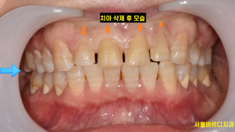 앞니 치아 사이 벌어짐 라미네이트로 컴플렉스 극복! 관련 이미지 6