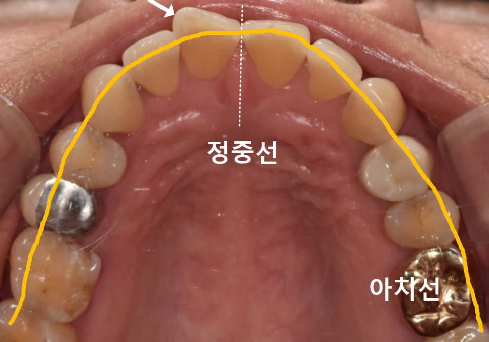 깨진 앞니 심미 치료, 라미네이트 vs 지르코니아 어떤 선택이 더 나을까? 관련 이미지 7