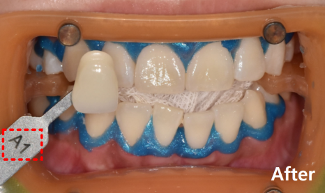 명일동 치과, 미백하면 연예인 치아처럼 새하얘진다는 말, 저는 못하겠습니다. 관련 이미지 10