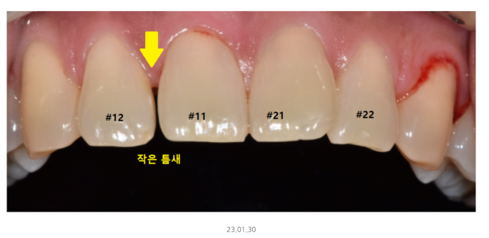 충치치료 레진 비용 이 금액이 맞나 궁금하신 분들을 위하여 관련 이미지 4