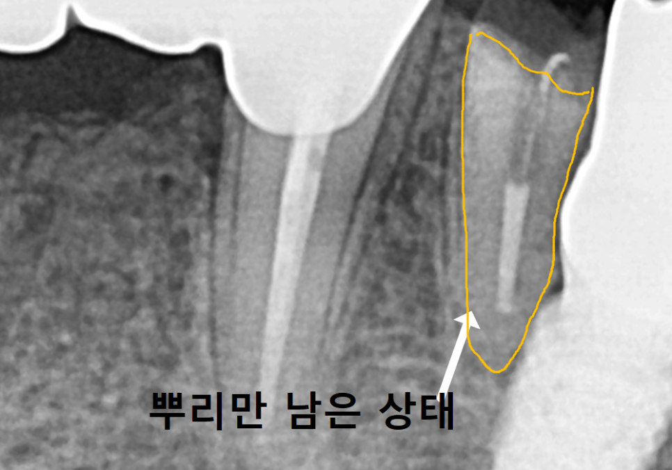 Godeok-dong Tooth Fracture: Check This Before Getting an Implant! Revealing the Criteria for Saving It image 11