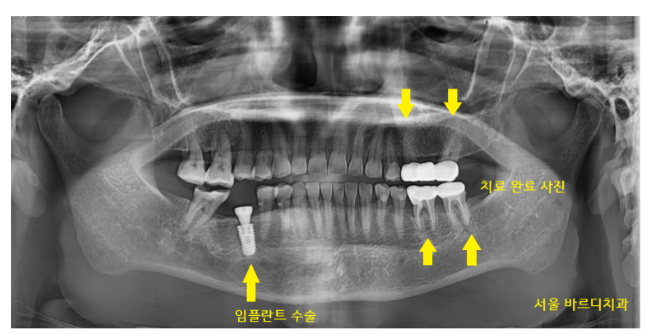 강동구 치과 약먹는게 많은데 임플란트 수술 할 수 있나요?? 관련 이미지 6