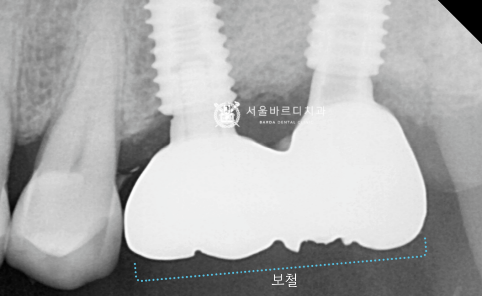 고덕동치과 서울바르디치과 무절개 네비게이션 임플란트 치료증례 #1 관련 이미지 17