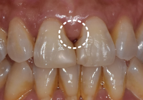 고덕동 치과 누런 이, 앞니 사이 틈, 잘못된 관리 때문일까? 관련 이미지 6