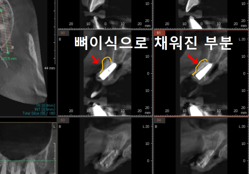 고덕동 임플란트, 튀어나온 앞니, 비용은 줄이고 자연스럽게 개선한 실제 사례 관련 이미지 9