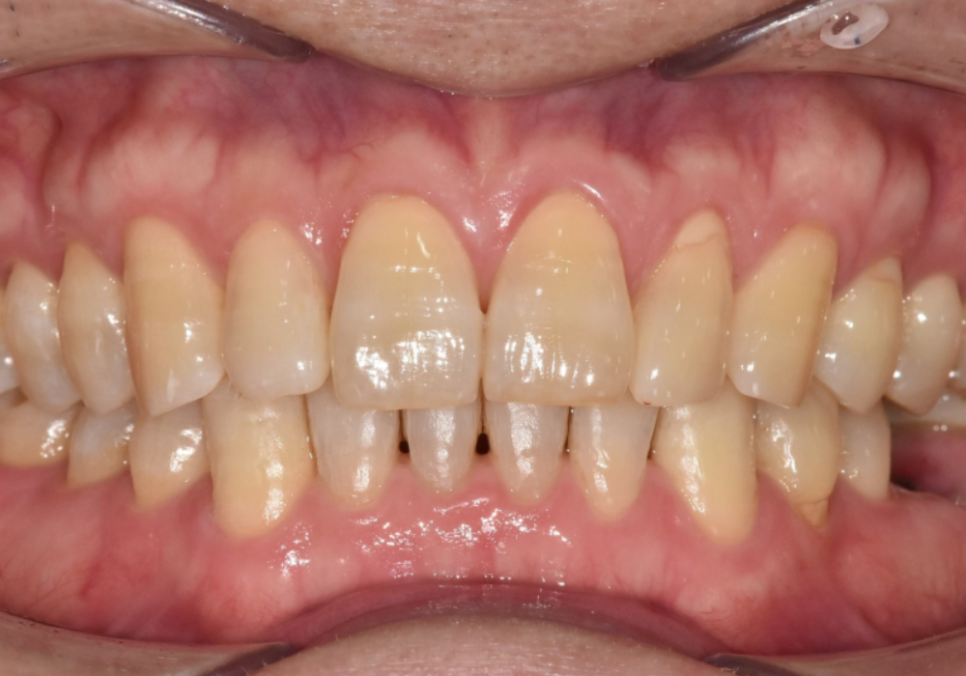 앞니 깨짐 치료 비용, 더이상 치과에 돈 낭비하기 싫다면? 깨지는 원인부터 알아야 합니다. 관련 이미지 9