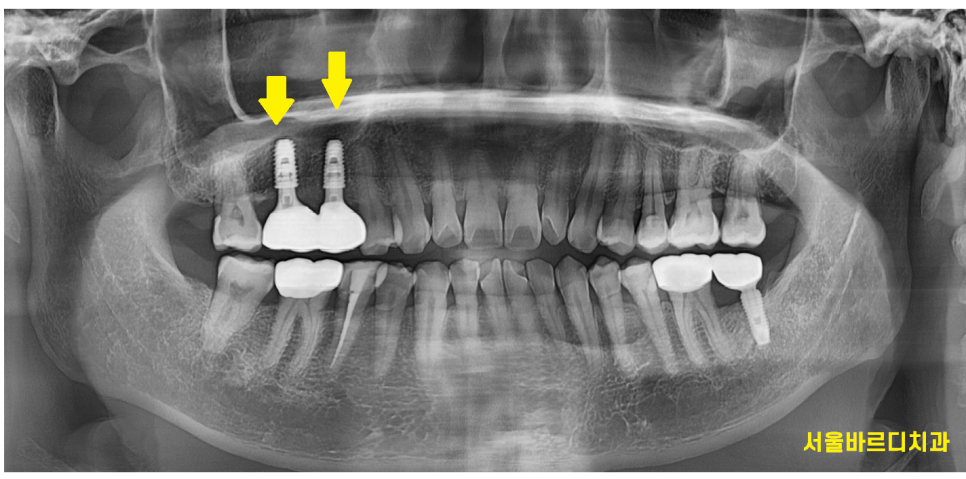 하남시청치과 신경치료 치아 발치 후 임플란트 했습니다. 관련 이미지 9