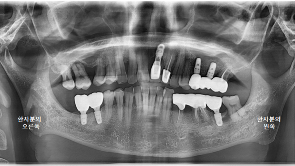 고덕동치과 서울바르디치과 전치부 및 구치부 임플란트 치료증례 #9 관련 이미지 38