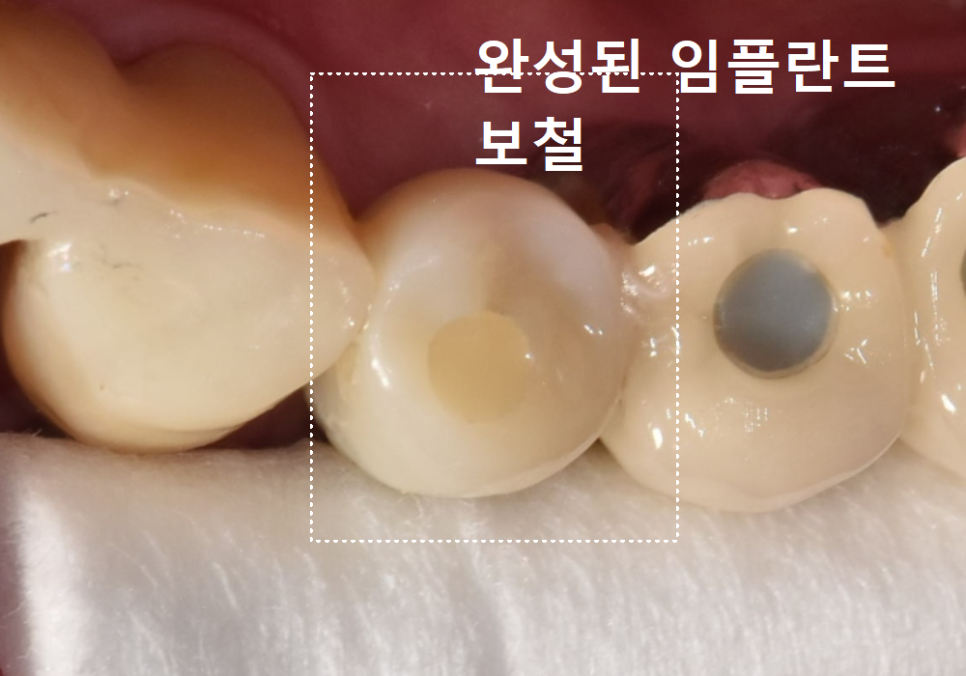 Godeok-dong Tooth Fracture: Check This Before Getting an Implant! Revealing the Criteria for Saving It image 15